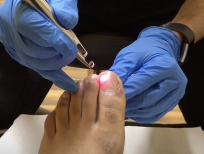 laser toenail fungus treatment in dallas tx