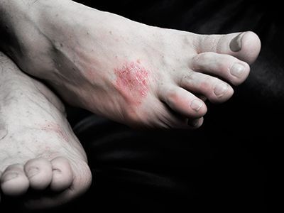 How to Recognize Psoriasis on Your Feet
