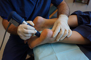 Shockwave Therapy for Heel and Achilles Pain