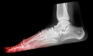 turf toe symptoms and causes
