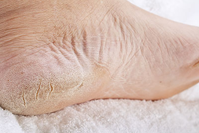 how to treat dry skin and cracked heels